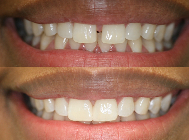 Close up of teeth before and after fixing gap between two front teeth with bonding
