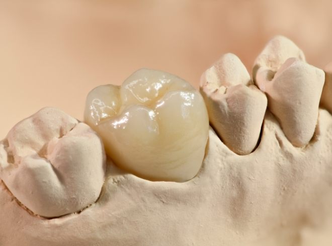 Dental crown on top of tooth in model of mouth