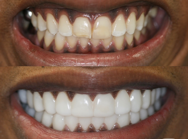 Close up of teeth before and after being enhanced with Snap On Smile
