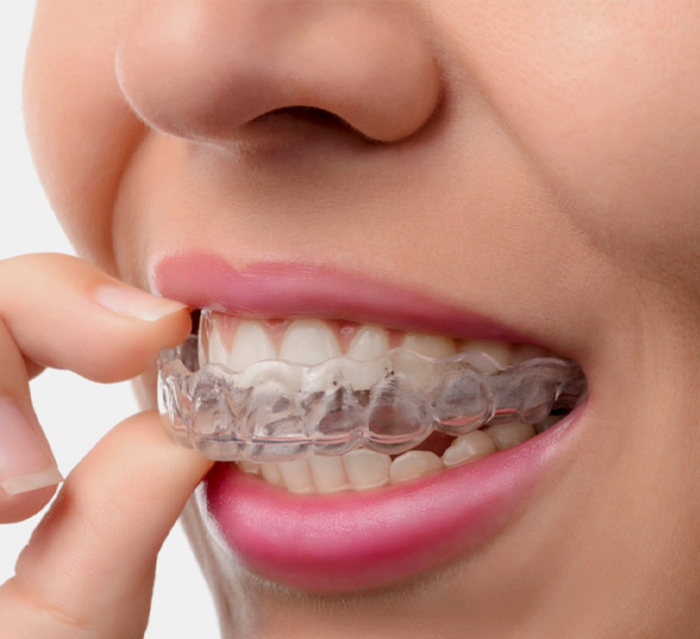 Close up of person placing Invisalign aligner in their mouth
