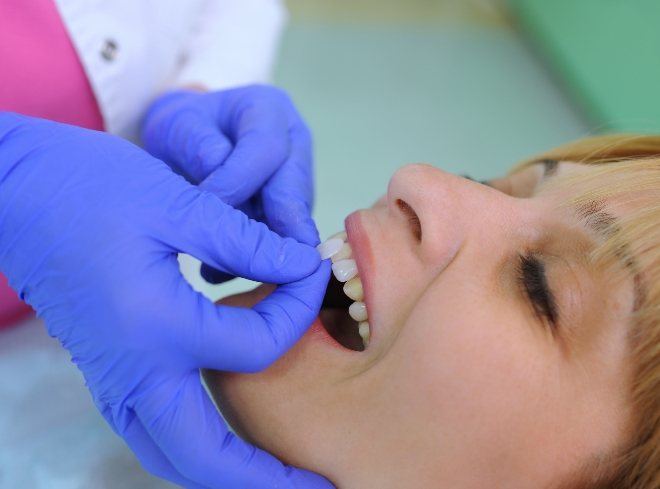 Dental patient getting veneer placed over her tooth