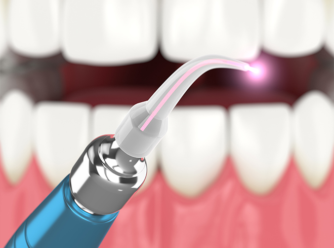 Animated dental laser treating gum disease