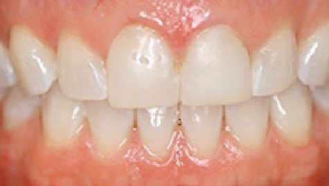 Close up of imperfect teeth before veneers and Lumineers