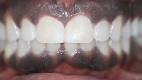 Close up of flawless smile after cosmetic bonding