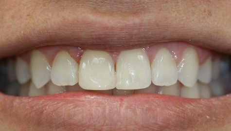 Close up of flawless smile after cosmetic bonding