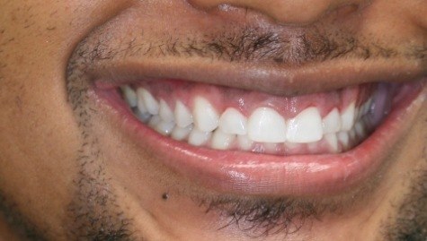 Close up of flawless smile after cosmetic bonding