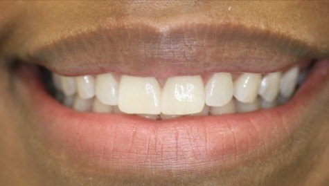 Close up of flawless smile after cosmetic bonding