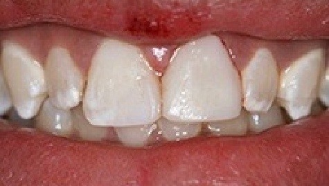 Close up of flawless smile after cosmetic bonding