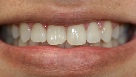 Close up of imperfect smile before cosmetic bonding