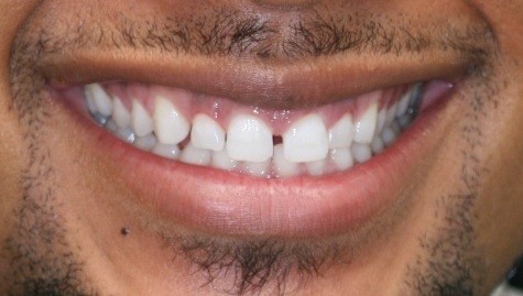 Close up of imperfect smile before cosmetic bonding