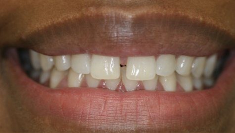 Close up of imperfect smile before cosmetic bonding