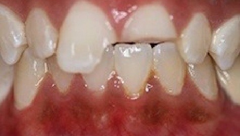 Close up of imperfect smile before cosmetic bonding