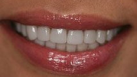 Close up of flawless smile after cosmetic dentistry