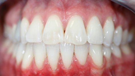 Close up of flawless smile after cosmetic dentistry