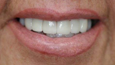 Close up of flawless smile after cosmetic dentistry