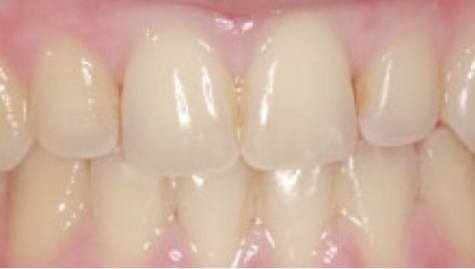 Close up of flawless smile after cosmetic dentistry