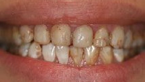 Close up of imperfect smile before cosmetic dentistry