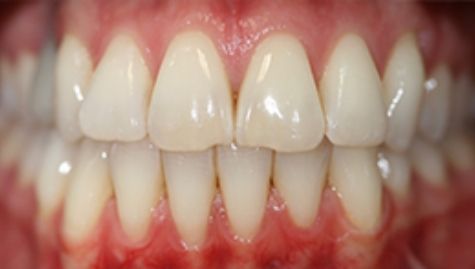 Close up of imperfect smile before cosmetic dentistry