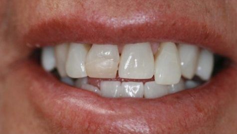 Close up of imperfect smile before cosmetic dentistry