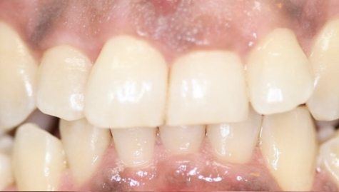 Close up of imperfect smile before cosmetic dentistry