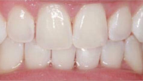 Close up of imperfect smile before cosmetic dentistry