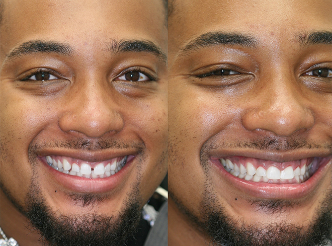 Man smiling before and after fixing his gapped teeth with cosmetic dental bonding