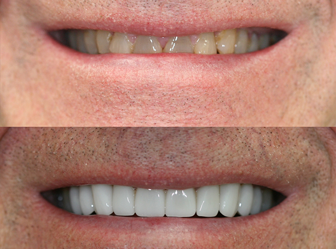 Close up of smile before and after enhancing teeth with dental crowns