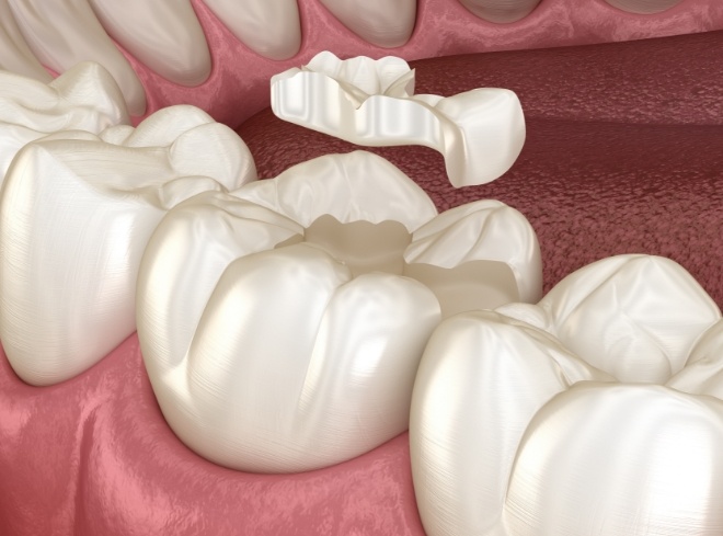 Animated dental onlay being placed over broken tooth
