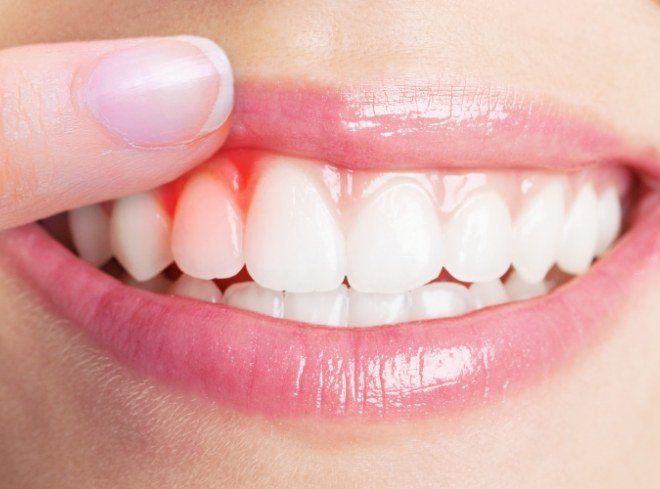 Close up of person pointing to red spot in their gums