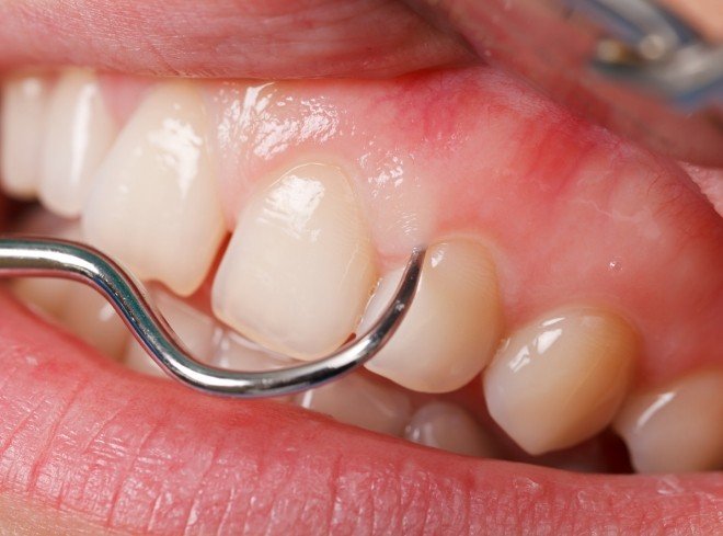 Close up of dental scaler treating gum disease