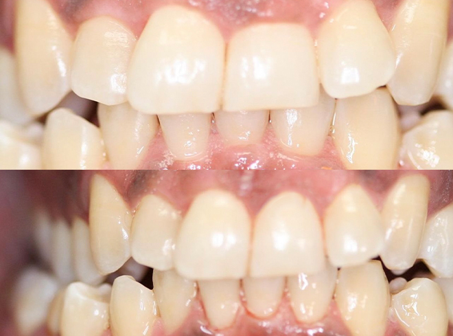 Close up of teeth before and after gummy smile correction