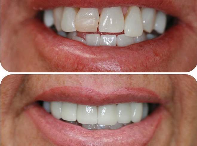 Close up of smile before and after getting a dental bridge