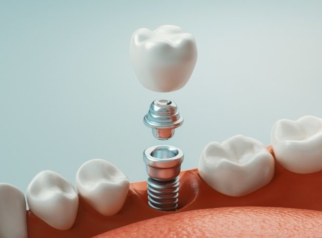 Animated dental implant being placed in the lower jaw