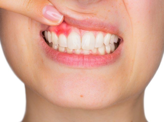 Person pointing to red spot in their gums