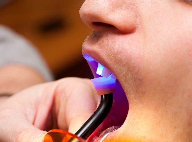 Close up of man getting cosmetic dental bonding on his front tooth