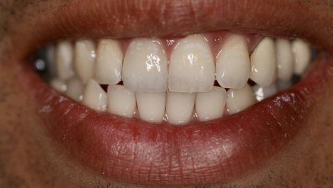 Close up of complete smile with dental implants