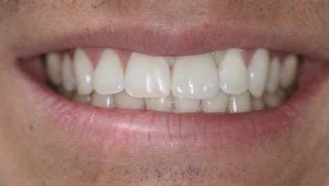 Close up of complete smile with dental implants