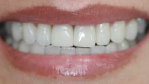 Close up of complete smile with dental implants