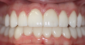 Close up of flawless teeth after cosmetic dentistry in Houston