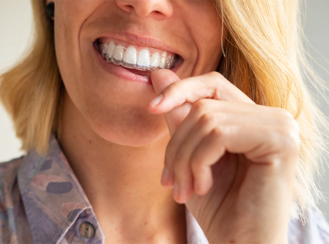 Blonde woman placing Invisalign aligner in her mouth