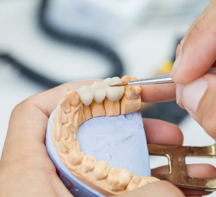 Dentist designing a metal free dental bridge