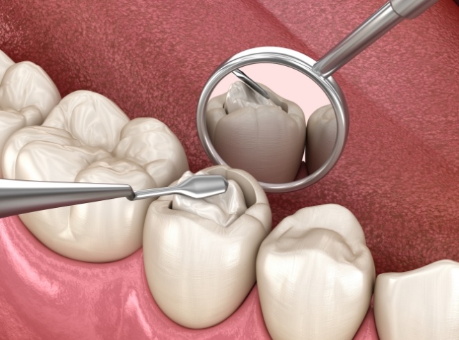 Animated model of tooth colored filling being placed in tooth