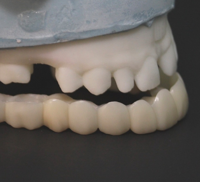 Close up model of Snap On Smile in Houston
