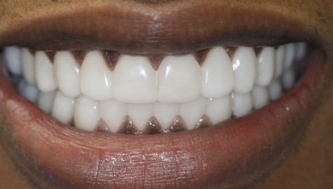 Close up of flawless teeth after Snap On Smile