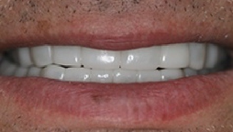 Close up of flawless teeth after Snap On Smile