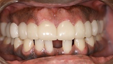 Close up of flawless teeth after Snap On Smile