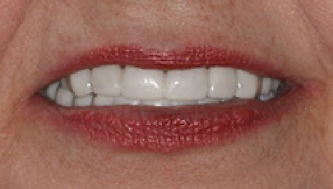 Close up of flawless teeth after Snap On Smile