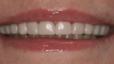 Close up of flawless teeth after Snap On Smile