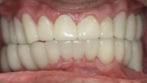 Close up of flawless teeth after Snap On Smile