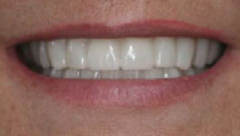 Close up of flawless teeth after Snap On Smile